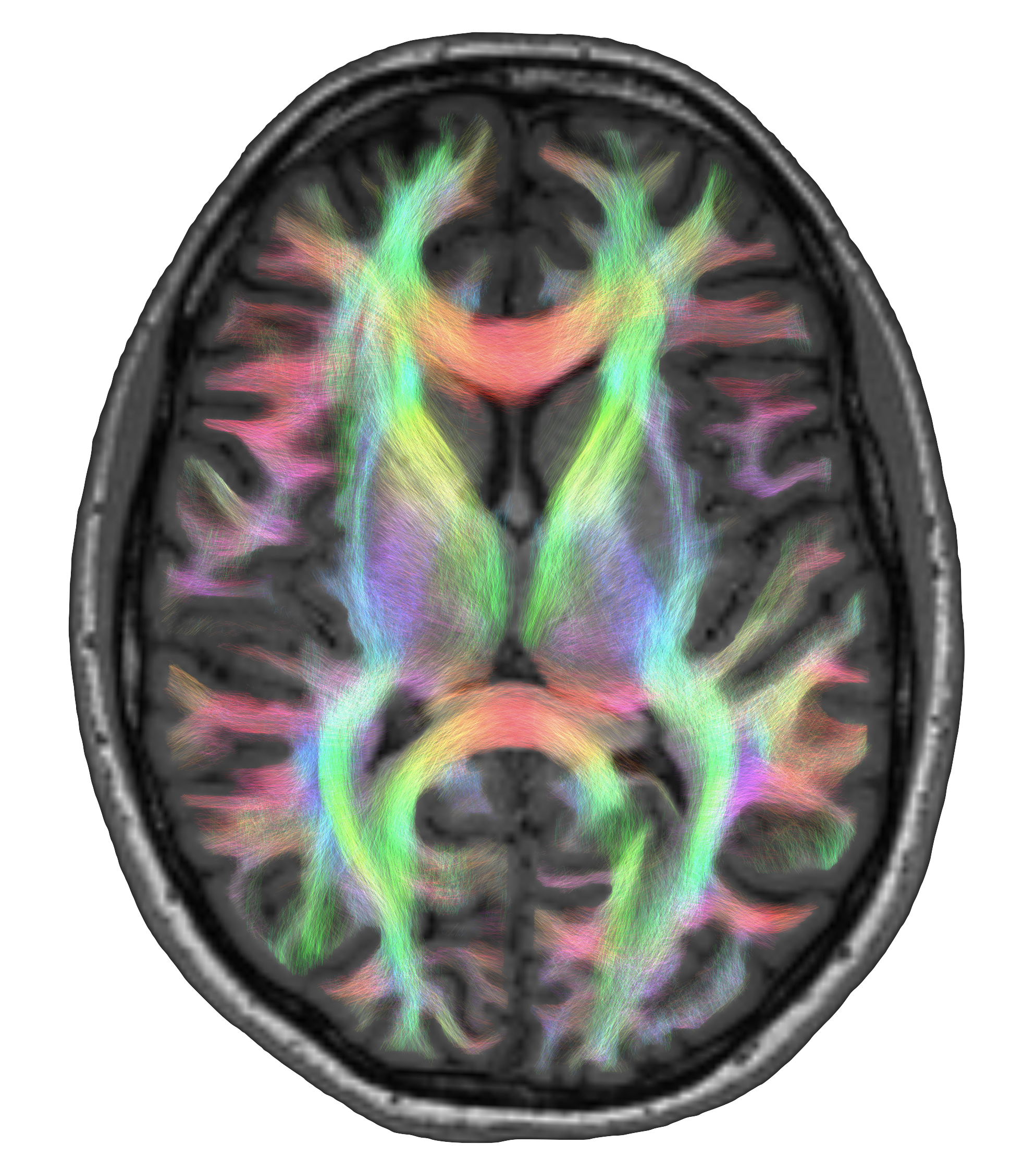 Whole-brain diffusion MRI tractography